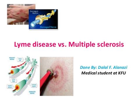 Lyme Disease Vs Ms