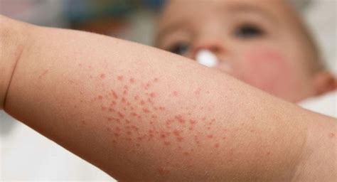 Insect Bites In Children Babycenter Diaper Rash Treatment Baby