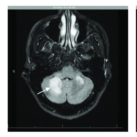 Initial Magnetic Resonance Imaging Mri Brain Demonstrating High T2