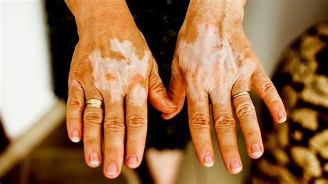 Vitiligo Types Causes And Who Gets It Everyday Health