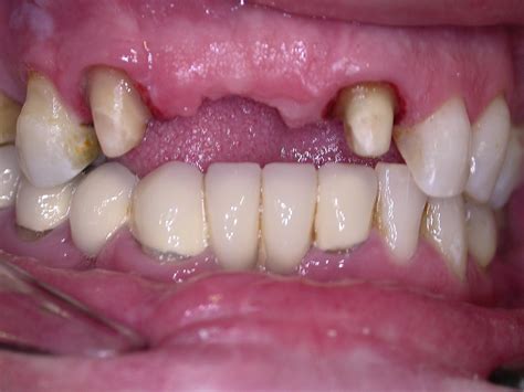 Prótesis dental fija y removible Clínica Dental Manuel Rodríguez Pérez