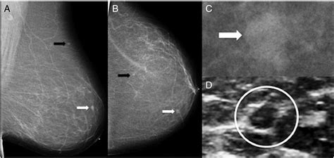 Metastatic Carcinoid Tumor To The Breast Report Of Two Cases And