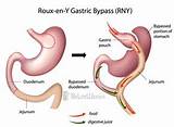 Images of Insurance Cover Gastric Bypass Surgery
