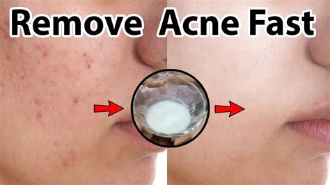 Home Remedy How To Remove Acne Scars From Face Diy Youtube