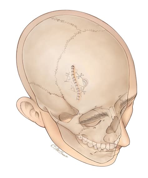 Open Skull Fracture The Neurosurgical Atlas