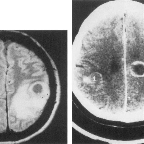 Postcontrast Computed Tomography Ct Scans Of A Patient With Seizures