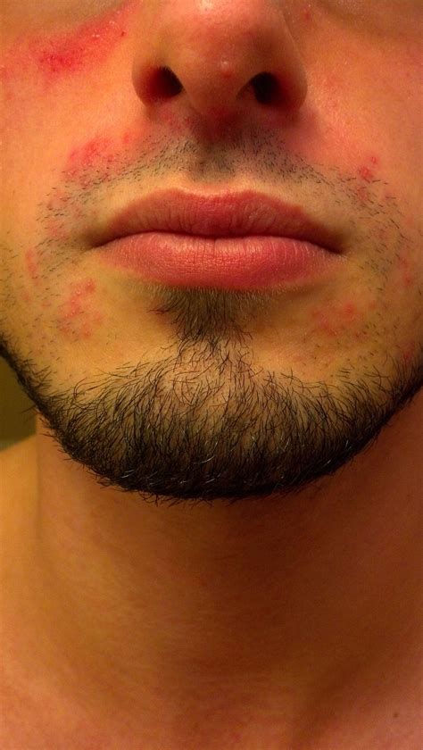 Rashpimplesdry Skin On Face Any Ideas To What It Could Be Dermatology