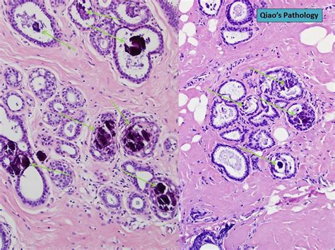 Qiaos Pathology Microcalcifications In Benign Breast Tissue A Photo