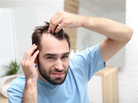Top 48 Image Hair Loss In Men Vn