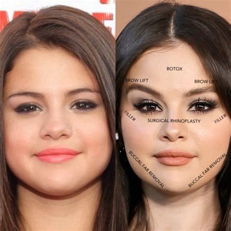 Selena Gomez Before And After Plastic Surgery In 2023 Botox Fillers