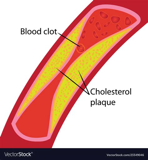 Blood Clot And Cholesterol Plaque Blocked Vessel Vector Image