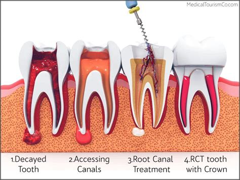 Root Canal Treatment Root Canal Therapy Endodontics Zanesville Dentist Dr Andy Fuhriman