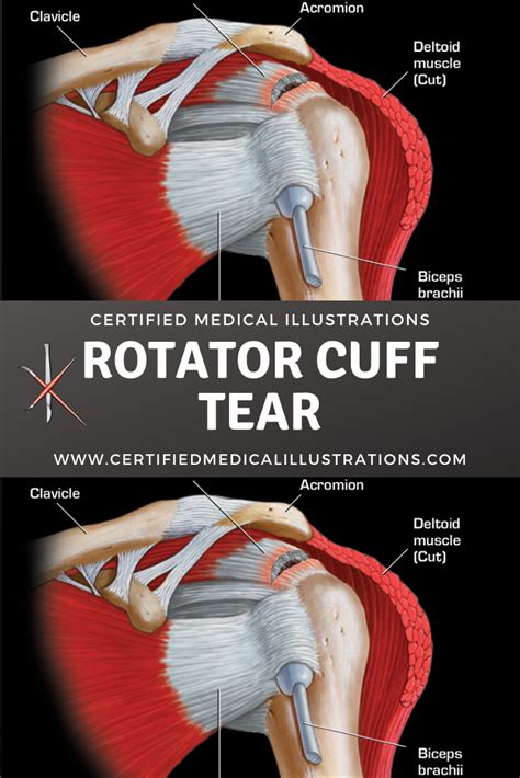 Rotator Cuff Injury Explained Including Rotator Cuff Tear