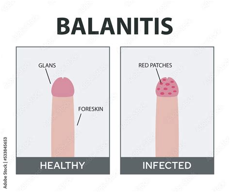 Candida Balanitis Vector Illustration Male Yeast Infection Vector De
