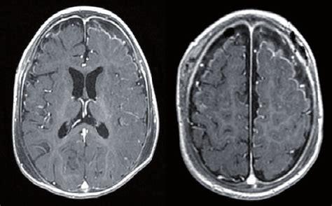 Diffuse Contrast Enhancement Of The Arachnoid Membrane And Dura