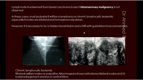 8 Sonomammography Acr Birad Breast Lymphadenopathy Youtube