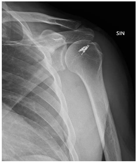 Jcm Free Full Text Posterior Shoulder Dislocation With Engaging