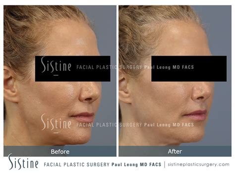 Lips Before And After 01 Sistine Facial Plastic Surgery