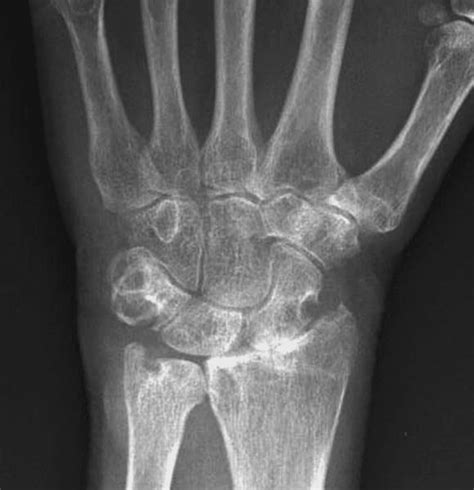 Typical Sites Of Osseous Erosion Of A Rheumatoid Wrist