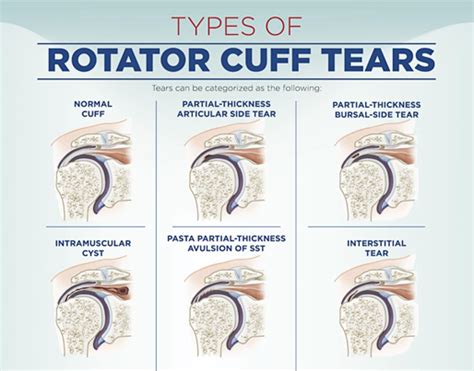 What Is Rotator Cuff The Hanitha Physiotherapy Centre Facebook