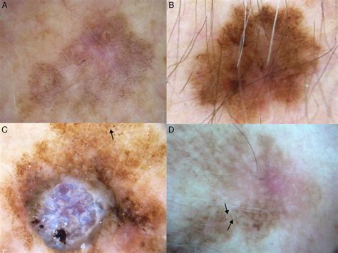 A D Dermoscopic Features Of Extrafacial Lentigo Maligna Lesions