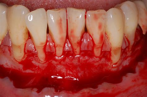 Periodontal Implant Cases By Dr Thomas Kang Free Gingival Grafts