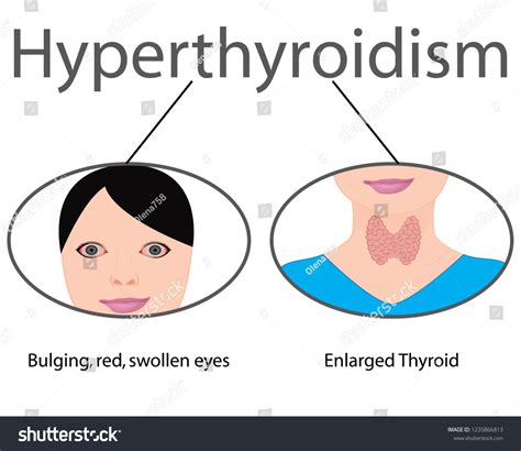 Hyperthyroidism Enlarged Thyroid Endocrine Disfunction Vector Stock