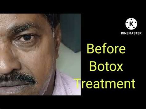 Botox Result In Hemifacial Spasm Youtube