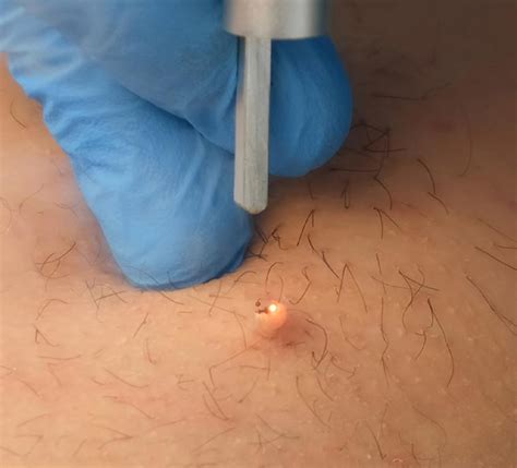 Warts Removal And Skin Tags Removal In Jacksonville FL