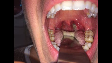 Examination Of The Oral Cavity Youtube