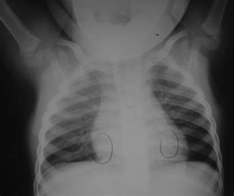 Bilateral Acute Posterolateral Rib Fractures On The Eighth Ribs Missed