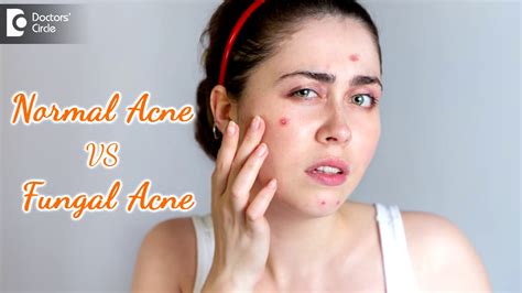 Difference Between Normal Acne And Fungal Acne Best Treatment Dr