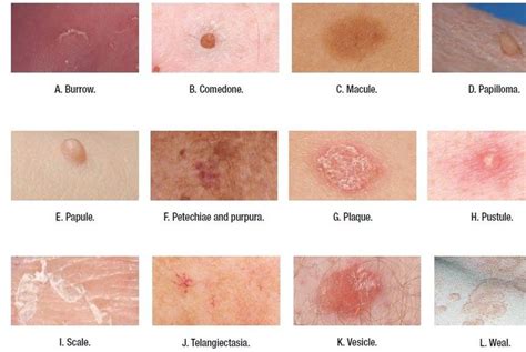 Types Of Skin Lesions Medical Addicts Dermatology Nurse Skin