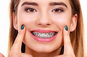 Woman smiling showing teeth with braces | Brodsky Orthodontics