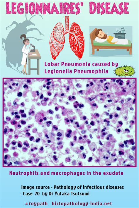 Pathology Of Legionellosis Legionnaires Disease Pathology Lung