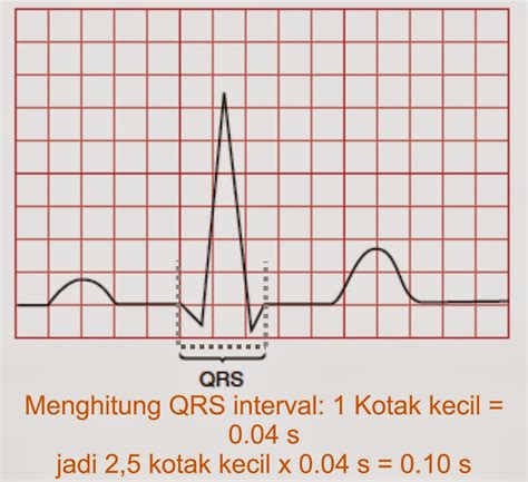 Karena banyaknya kegunaan dari ekg maka interpretasinya harus dilakukan secara sistematis agar tidak. Interpretasi EKG 5 Langkah