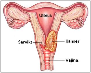 Apabila semakin dekat dengan tempoh ovulasi, anda akan mengalami keputihan yang licin dan panjang. Tanda Kanser Rahim Apabila Keputihan Berwarna Coklat ...