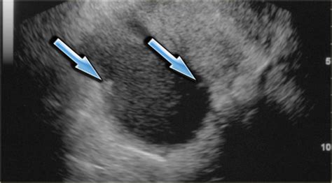 Endometrioma Cyst