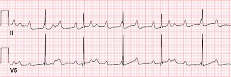 Other topics in this chapter. Complete Atrioventricular Block Third-Degree Heart Block ...