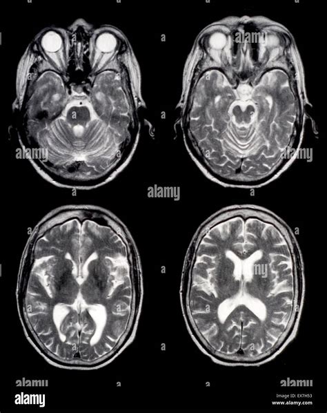 Axial Brain Mri Images Of A Normal 65 Year Old Woman Stock Photo