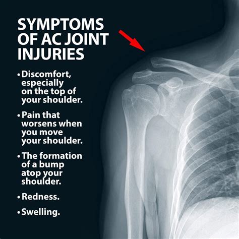 Ac Joint Injuries Florida Orthopaedic Institute