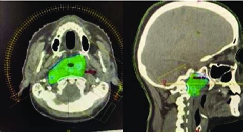 Planning Images Of Re Irradiation Treatment Applied With Volumetric