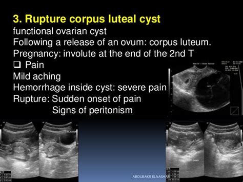 Corpus Luteum Cyst Rupture During Early Pregnancy Pregnancywalls
