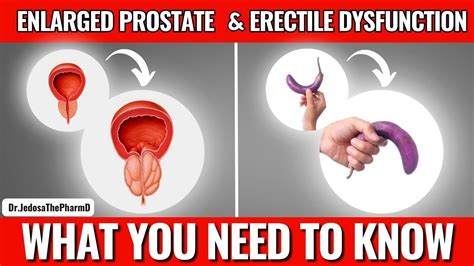 Enlarged Prostate And Erectile Dysfunction The Facts Every Man Should Know YouTube
