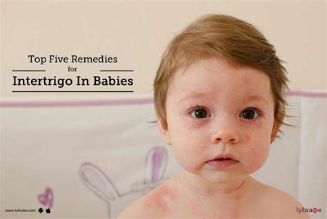 Intertrigo, erythema intertrigo, eczema intertrigo, superficial dermatitis on opposed skin surfaces. Top Five Remedies For Intertrigo In Babies - By Dr. Atul ...
