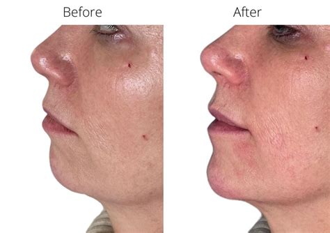 Cheek Chin And Temple Fillers Melior Clinics