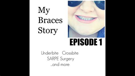 My Braces Story Episode 1 Youtube
