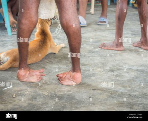 A Person With Leg Deformities Due To Polio Or Other Diseases In The