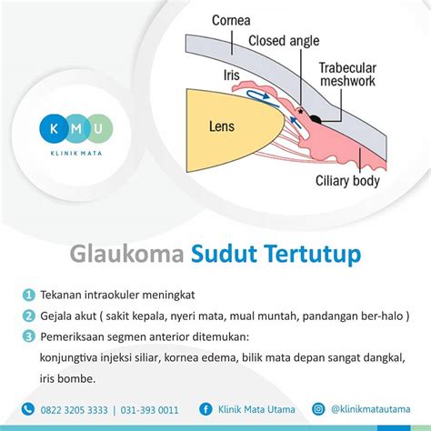 Glaukoma Sudut Tertutup Pusat Katarak