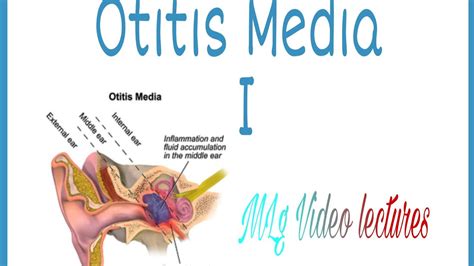 Otitis Media Mlg Video Lectures Part 1 Youtube